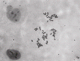 Fib Karyotype thumbnail image
